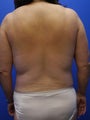Zeltiq CoolSculpting