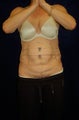 CoolSculpting®