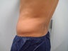 CoolSculpting