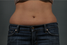 Liposuction of the Abdomen