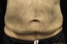 CoolSculpting