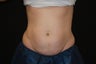 Coolsculpting - Non Invassive Fat Reduction