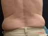 Coolsculpting