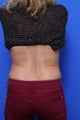CoolSculpting 