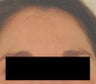 Melasma Treatment 