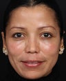 Cosmelan MD for Facial Pigmentation