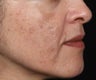 Cosmelan for Dark Spots from Acne