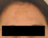 Melasma Treatment 