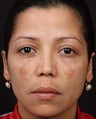 Cosmelan MD for Facial Pigmentation