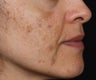 Cosmelan for Dark Spots from Acne