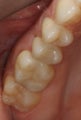 Replacing Old Silver Fillings With Porcelain Fillings
