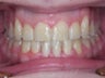 Damon Braces
