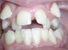 Damon Braces