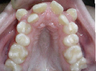 Damon Braces