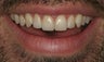 Ceramic crowns after trauma