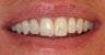 Single tooth porcelain crown and single tooth veneer