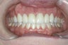Dental Crown