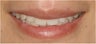 Dental Crown