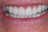 e-max crowns
