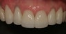 All-Ceramic Crowns