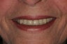 Full-mouth Reconstruction