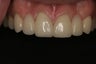 Dental Crowns 