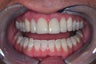 dental crown