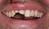 Ceramic crowns after trauma