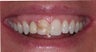 Single tooth porcelain crown and single tooth veneer