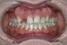 Dental Crown
