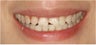 Dental Crown
