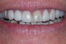 e-max crowns