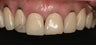 All-Ceramic Crowns