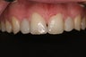 Dental Crowns 