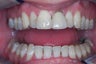 dental crown