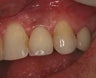 Dental implant placement and restoration following a tooth extraction
