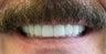 Full mouth rehabilitation using  20 implants to restore 28 teeth