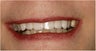 Dental Implant
