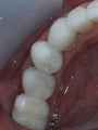 Missing lower teeth replaced with bone grafting and implants