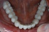 Implants to support a fixed bridge for a patient with all teeth missing