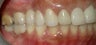 Implant