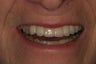 Implant Bridge
