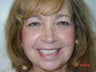 Implant supported full dentures 