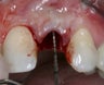 Dental implant placement and restoration following a tooth extraction