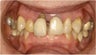 Dental Implant