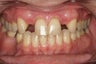 Implants Replacing Two Front Teeth