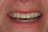 Implant Bridge