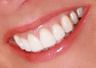 Gum Lift and Porcelain Veneers