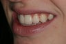 Cosmetic Bonding