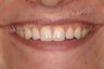 Cosmetic Bonding to close space